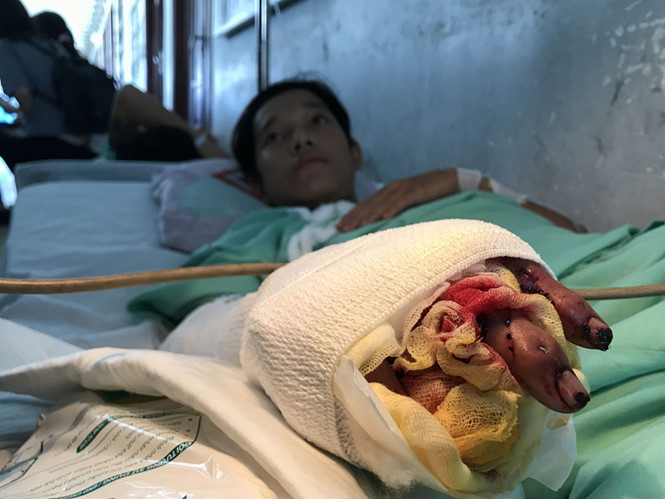 Mổ khẩn cấp nối 4 ngón tay bị đứt của bệnh nhân 17 tuổi